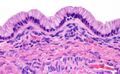 Ovarian tumor