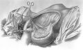William Stewart Halsted, Surgical papers