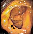 Ileocecal valve