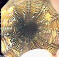 Self-Expanding Metal Stent (SEMS)