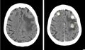 MRI image showing brain metastasis from breast cancer