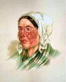 Lupus erythematosus, Atlas der Hautkrankheiten