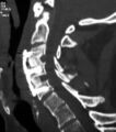 Spinal cord compression