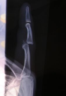 Radiograph of left index finger dislocation