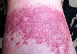 Vasculitis
