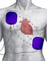 Demonstration of electrode pad placement for defibrillation