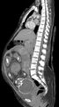 Median plane CT scan of a pregnancy of 37 weeks of gestational age