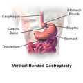 Bariatric surgery