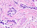 Gene expression profiling in cancer