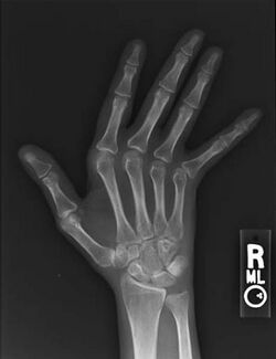 Jaccoud arthropathy hand x-ray front