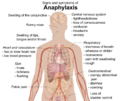 Signs and symptoms of anaphylaxis