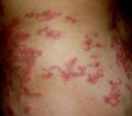 Serpiginous