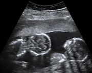 Ultrasound of Monoamniotic Twins