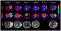PET scans of brain tumor using Sigma-2 Ligands