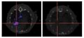 Adenoviral NIS gene expression in a mouse tumour