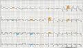 12 Lead EKG showing ST Elevation