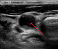 70% blocked right carotid artery