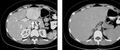 Late arterial and portal venous phase CT of focal nodular hyperplasia