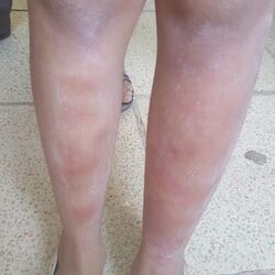 Erythema nodosum