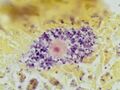 Gram stain of a macrophage with ingested S. epidermidis bacteria