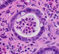 Histopathology of a crypt abscess