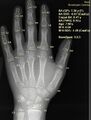 X-ray of hand, where bone age is automatically found by BoneXpert software