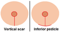 Mastopexy