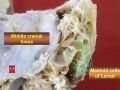 Mastoid cells of Lenoir