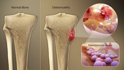 3D Medical Animation Staphylococcus Aureus