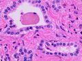 Histopathology of a bile duct hamartoma, high magnification