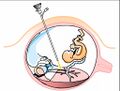 Illustration of fetoscopic laser ablation