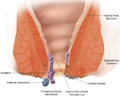 Diagram showing hemorrhoids