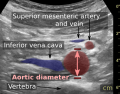 Ultrasonographic measurement of aortic diameter