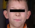 Otoplasty