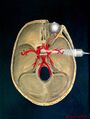 Transcranial Doppler