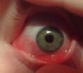 Eye with allergic conjunctivitis