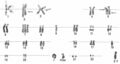 Human karyotype from bladder carcinoma, including ring chromosome