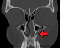 Fracture of left nasal bone