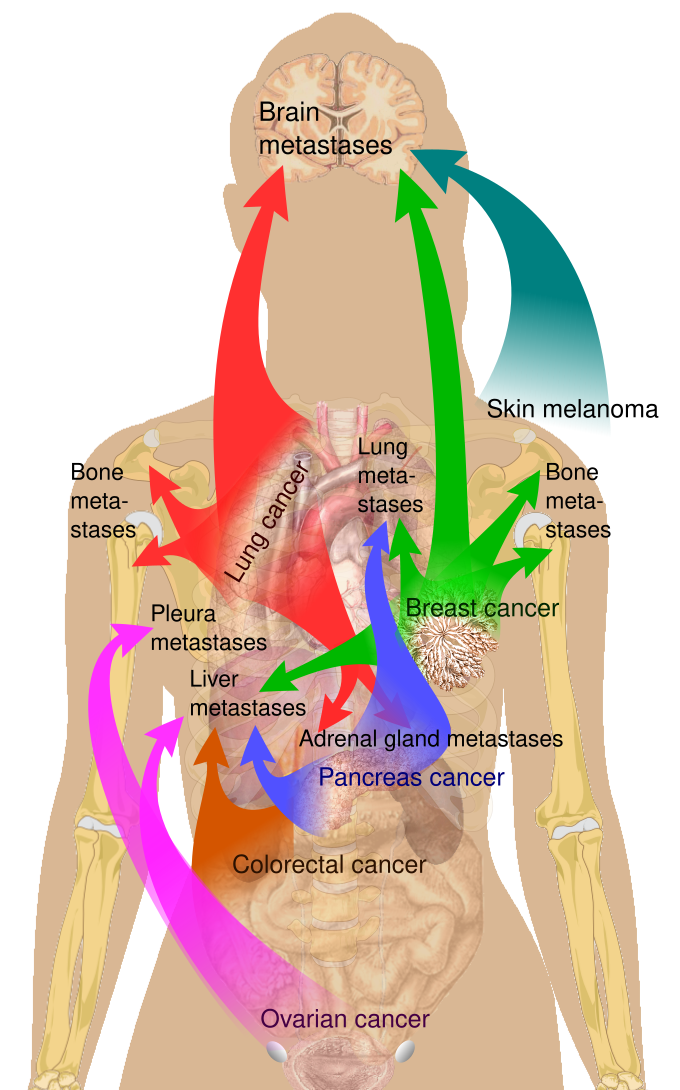 Summary of metastasis sites for common cancers