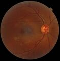 Optic_disc