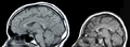 Microcephaly