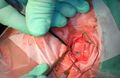 Eye surgery