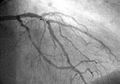 Coronary catheterization