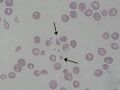 Schizocytes seen in a blood smear, indicative of hemolytic anemia.