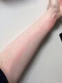 Lymphangitis after bed bug bites