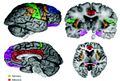 Schematic of cortical areas involved with pain processing and fMRI