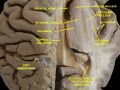 Lentiform nucleus