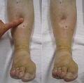 Pedal edema