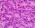 Carcinoma adenoides ventriculi (low differentiated)