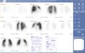 Lung Scintigraphy